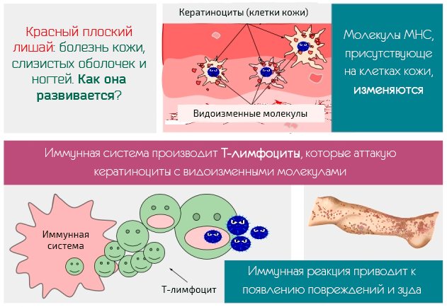 Лишай схема лечения у человека